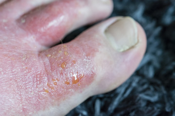 Eczema wetting - Skin disease on the foot of the foot.