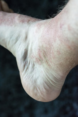 Eczema - Foot disease on the foot of the foot.