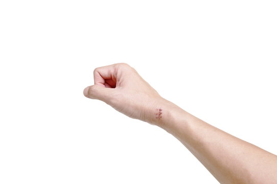 hand with suture scar after surgery on white background