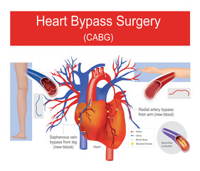 Heart bypass surgery.