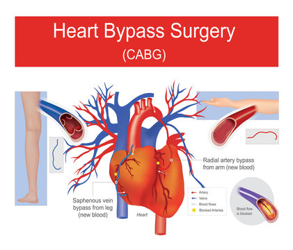 Heart bypass surgery.