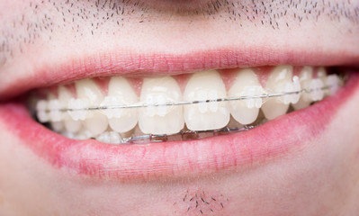Macro shot of white teeth with braces. Smiling male patient with metal brackets at the dental office