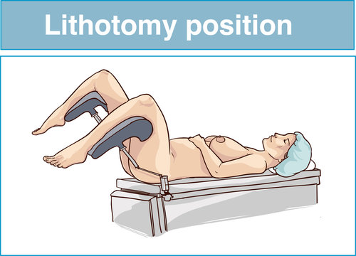 Lithotomy position