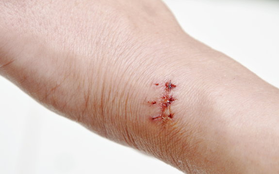hand with suture scar after surgery on white background