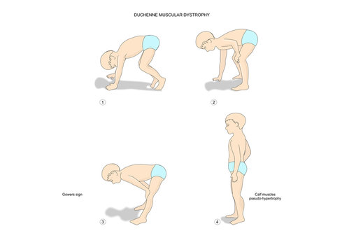 Sequence Of Movements Of A Boy With Duchenne Muscular Dystrophy And Gowers Sign.