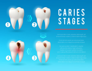 Tooth decay 3d poster of dental caries development