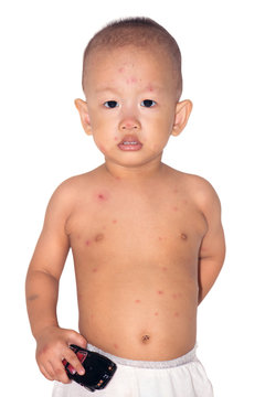 Baby boy with chicken pox