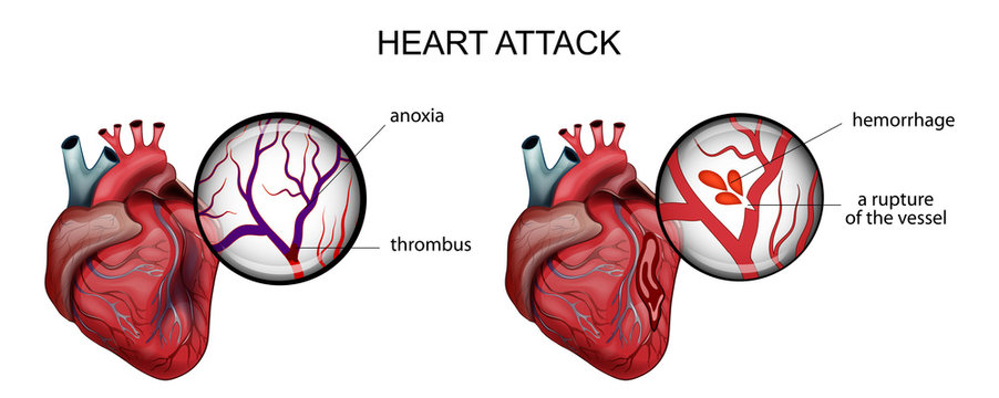 myocardial infarction. thrombosis and hemorrhage