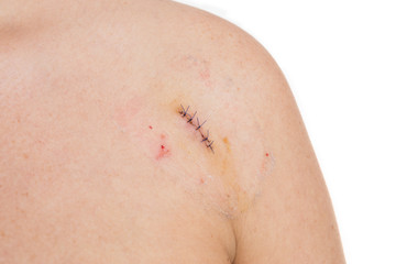 Birthmark or mold removal concept with stitches or strings