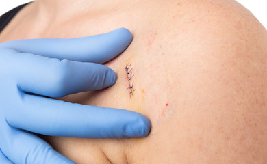 Dermatologist or plastic surgery doctor checking mold removal stitches
