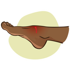 Illustration First Aid person, afro descent, standing side view, with a foot injury, cut with bleeding. Ideal for catalogs, information and medicine guides