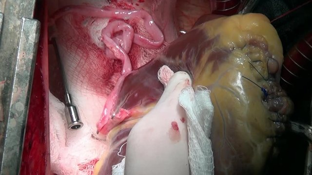 Cut heart plane by surgeon professional doctor unique macro video in clinic. Process of struggle for life of patient. Operation on live organ of person in hospital.