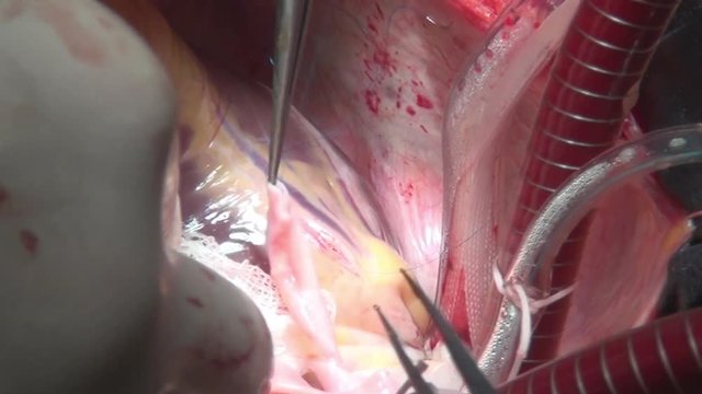 Surgeon sews up heart during operation on live organ of person in clinic. Process of struggle for life of patient. Unique macro video in hospital.