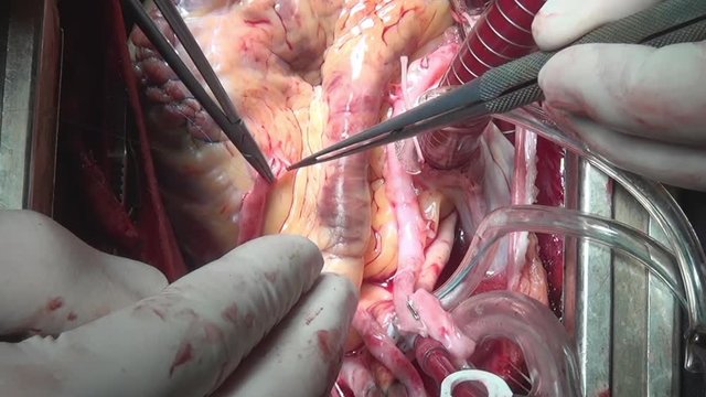 Heart surgery on live organ of person in clinic. Process of struggle for life of patient. Unique macro video in hospital.