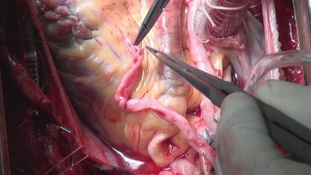 Heart surgery on live organ of person in clinic. Process of struggle for life of patient. Unique macro video in hospital.