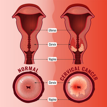 Cervical cancer image