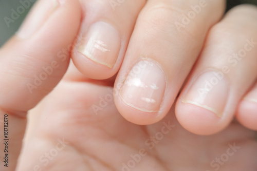 close Up White Spot On Finger Nails Called Leukonychia Sickness close-up-white-spot-on-finger-nails-called-leukonychia-sickness