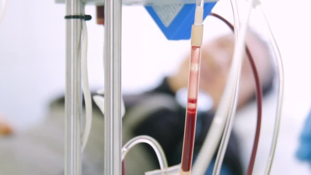 Plasmapheresis - the process of excretion of blood plasma from the circulation