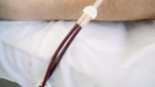 Plasmapheresis - the process of excretion of blood plasma from the circulation