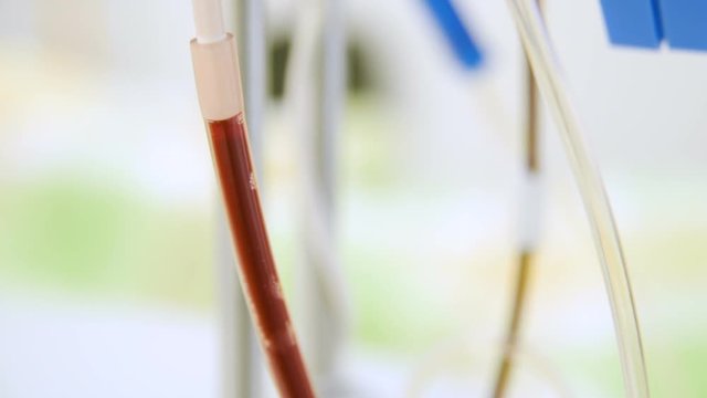 plasmapheresis - the removal of plasma from the blood. Plasma in a special medical bag