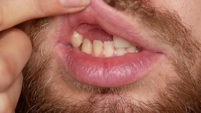 The toothless man laughs. A bearded man without teeth