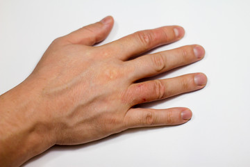 Hand dermatitis. Hand eczema