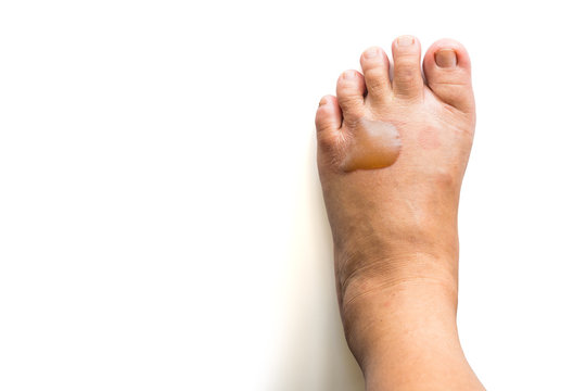 The scald on the foot skin caused by the boiling cooking oil