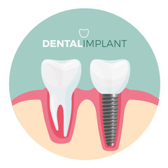 Dental implant placard with title on vector illustration