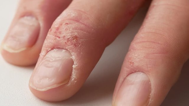 Close-up of a man's fingers suffering from psoriasis. Eczema on the hands