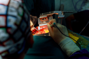surgeon help wound with surgical instrument during the open heart operation