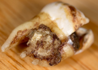 Caries on the teeth of a man