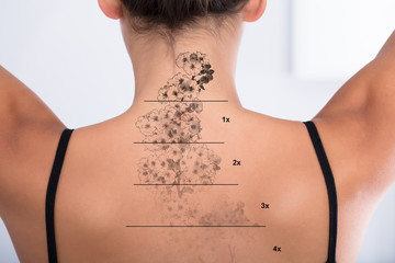 Tattoo Removal On Woman's Back - obrazy, fototapety, plakaty