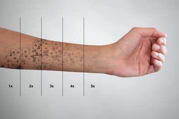 Tattoo Removal On Woman's Hand