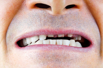 Missing teeth in man mouth closeup