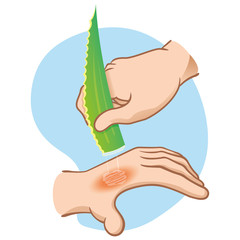 Illustration first aid hands with burn and injury, passing aloe vera, caucasian. Ideal for medical, informative and institutional catalogs