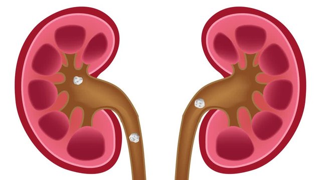 Kidney stones medical concept graphic . anatomy
