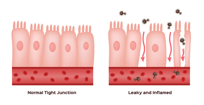 Celiac disease Small intestine lining damage. good and damaged villi . leaky gut progression