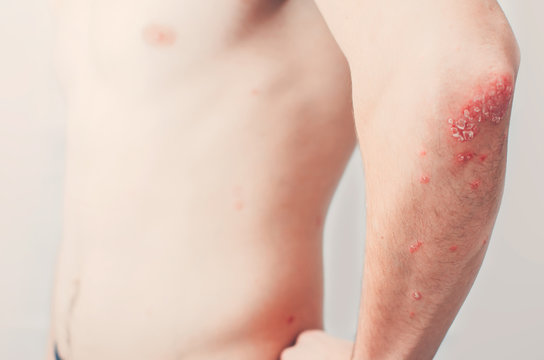 on the Elbows Psoriasis