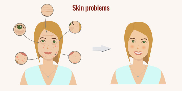 Woman's face with skin problems before and after . Wrinckles, acne, pimples, dark circles under eyes. Skin troubles. Skin treatment, rejuvenation. Vector illustration.