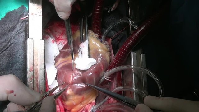 Cut heart operation on live organ unique macro video in clinic.Process of struggle for life of patient. Operation on live organ of person in hospital.