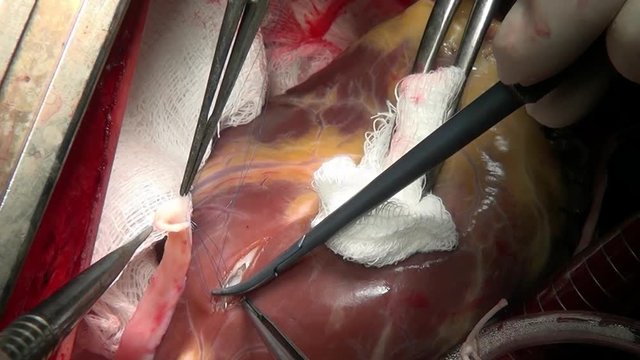 Heart surgery in clinic. Process of struggle for life of patient. Unique macro video in hospital.