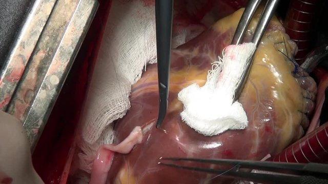 Heart surgery in clinic. Process of struggle for life of patient. Unique macro video in hospital.