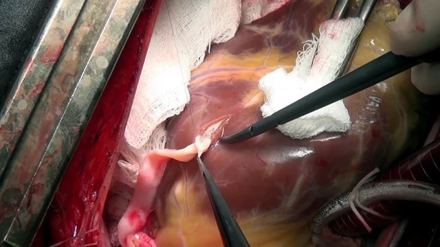 Heart surgery in clinic. Process of struggle for life of patient. Unique macro video in hospital.
