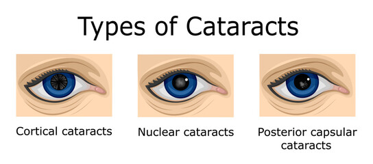 Types of Cataracts