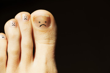 nail fungus. feet care © Angelina