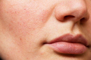 pores on the face