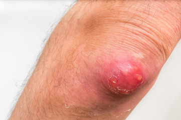 Detailed view of elbow with carbuncle or furuncle