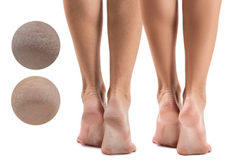 Feet with dry skin before and after treatment.