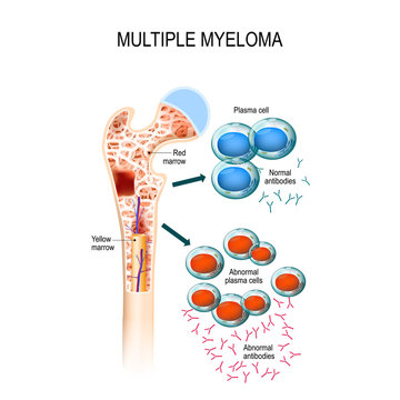 Multiple myeloma. plasma cell myeloma