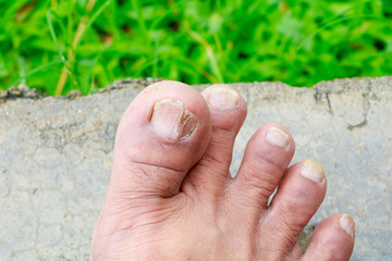 ingrown nail Big toe broken toenail on floor with copy space